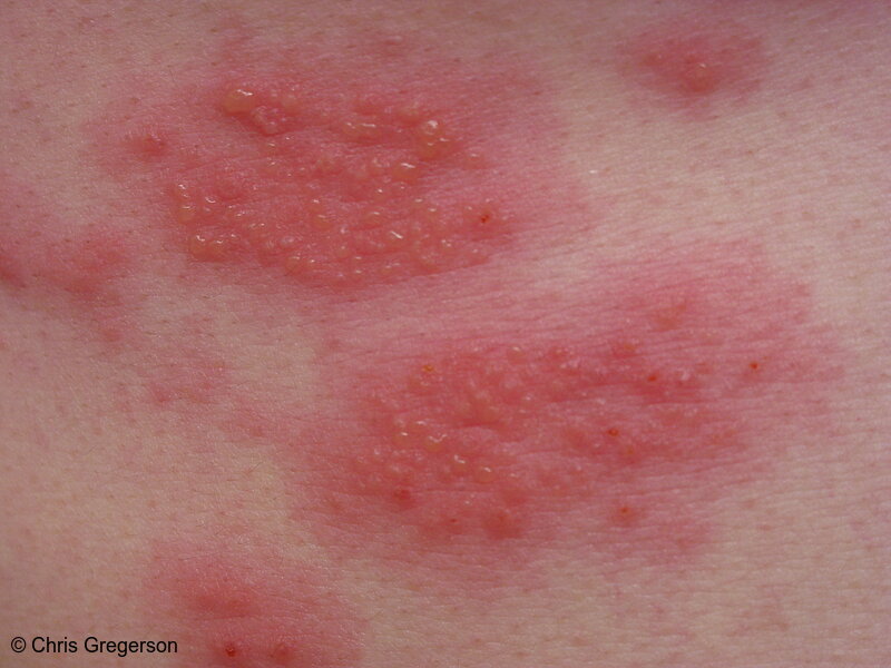 Photo of Urishiol Contact Dermatitis or Shingles(6544)