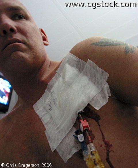Man with a Bleeding Central Line Catheter